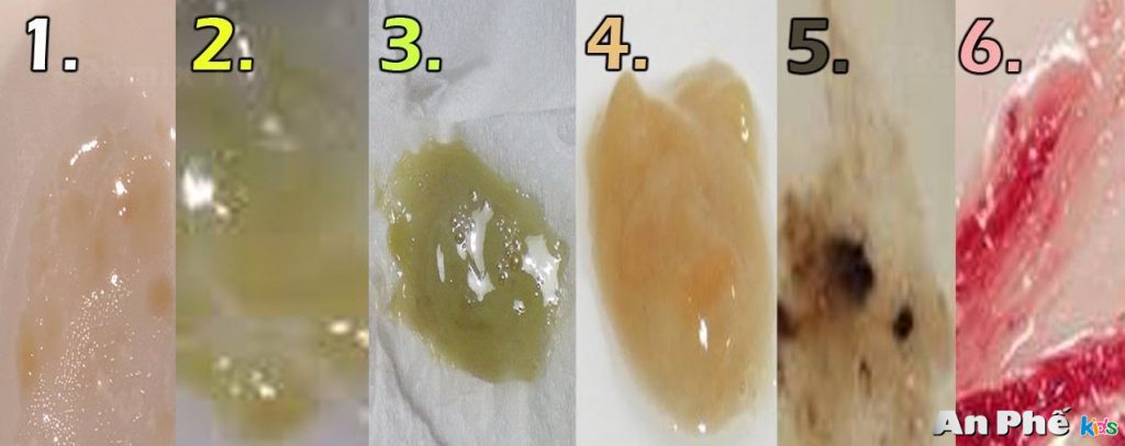 viêm phế quản có đờm đặc - Image 2