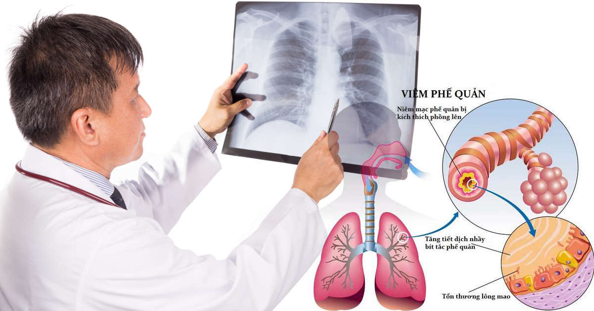 viêm phế quản có đờm đặc - Image 4