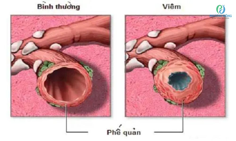 viêm phế quản kéo dài nhiều tuần