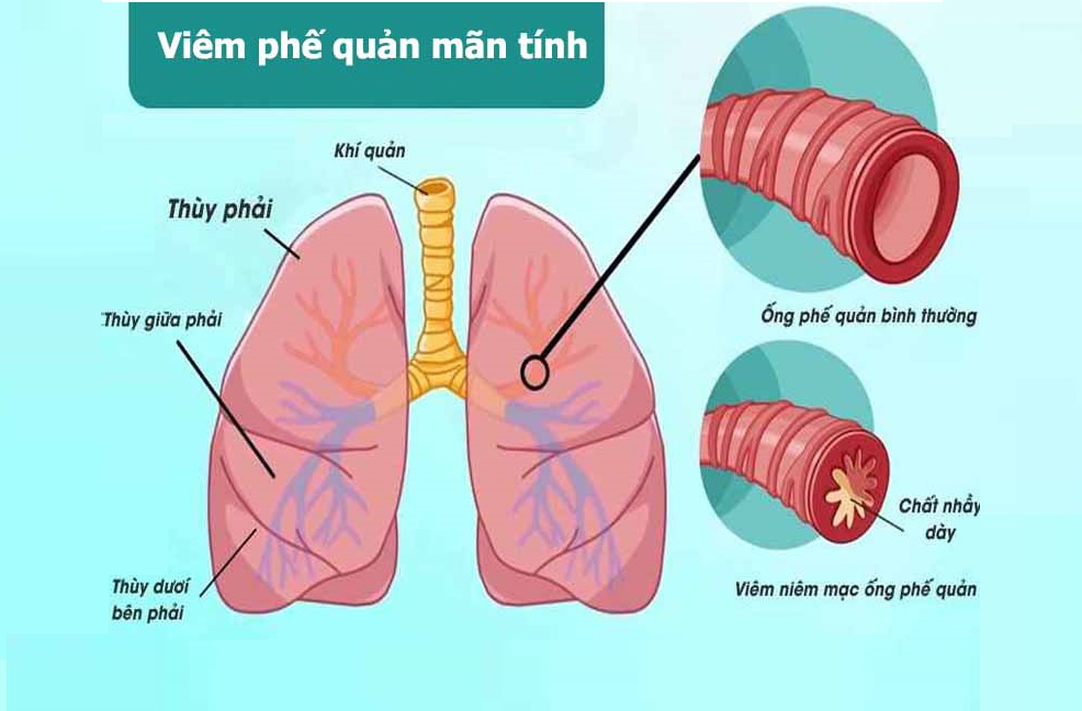 viêm phế quản mạn tính - Image 2