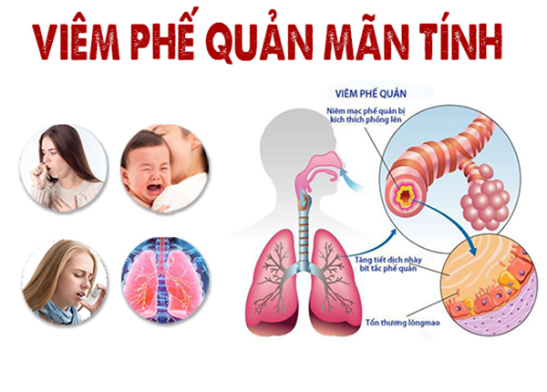 viêm phế quản mạn tính - Image 4