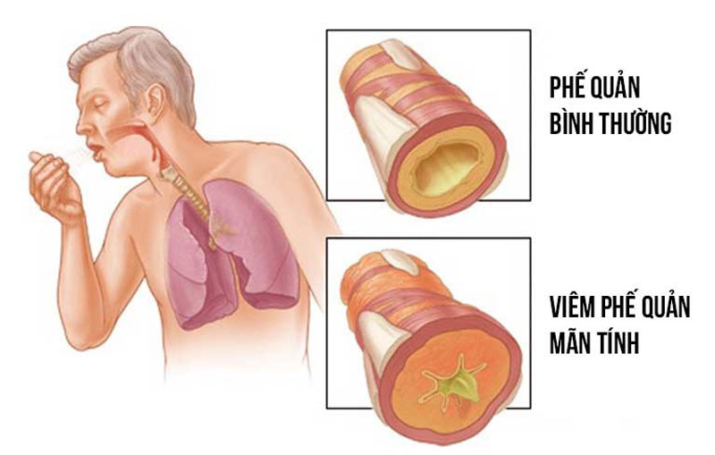 viêm phế quản mạn tính