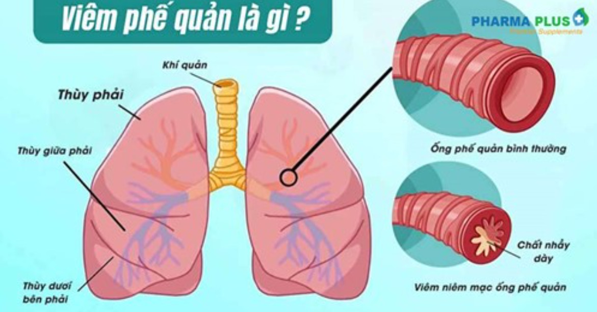 viêm phế quản ở người cao tuổi - Image 3