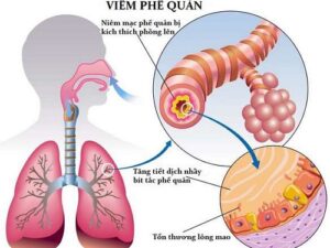 viêm phế quản ở người cao tuổi