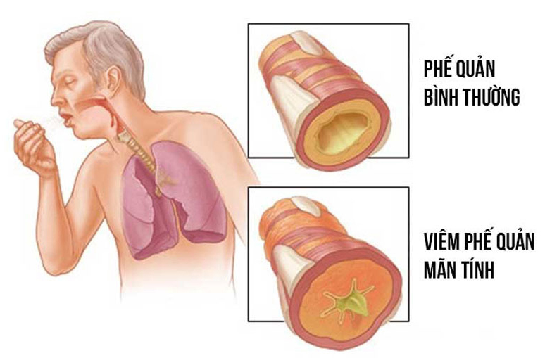 viêm phế quản ở người cao tuổi - Image 5