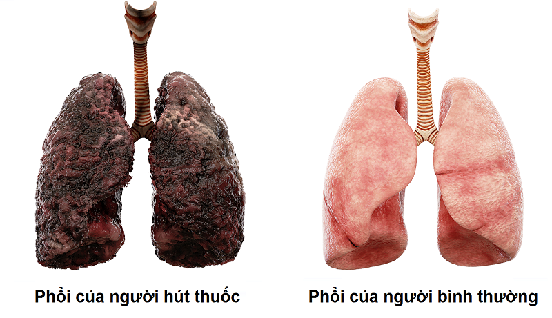 viêm phế quản ở người hút thuốc - Image 1