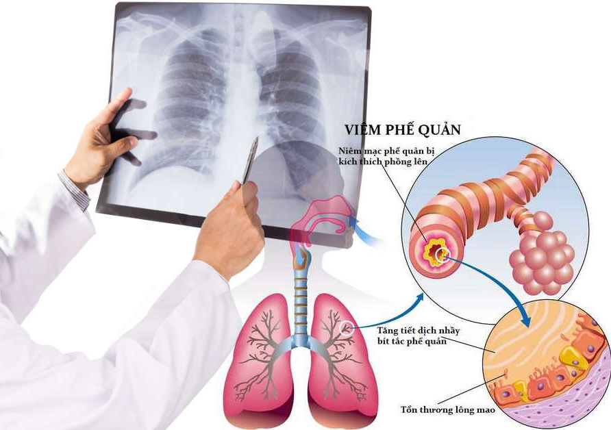 viêm phế quản ở người hút thuốc - Image 3
