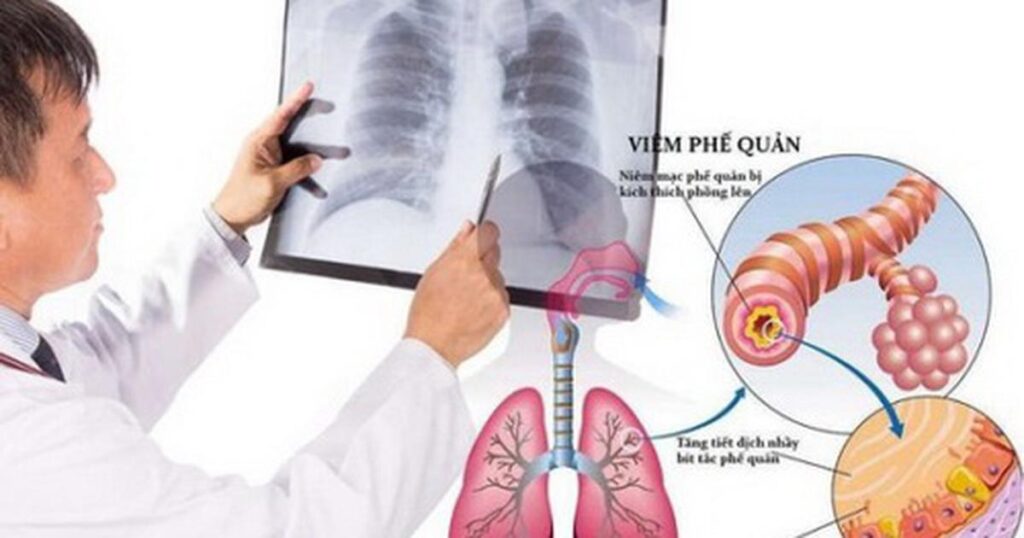viêm phế quản tái phát ở người lớn