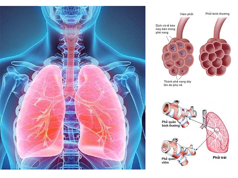 viêm phế quản tái phát ở người lớn - Image 3