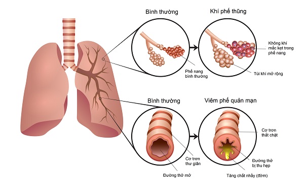 viêm phế quản và copd - Image 2
