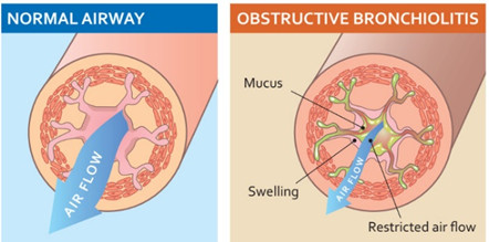 viêm phế quản và copd - Image 3