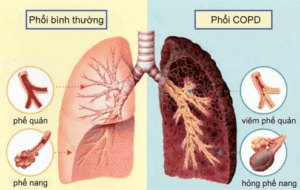 viêm phế quản và copd