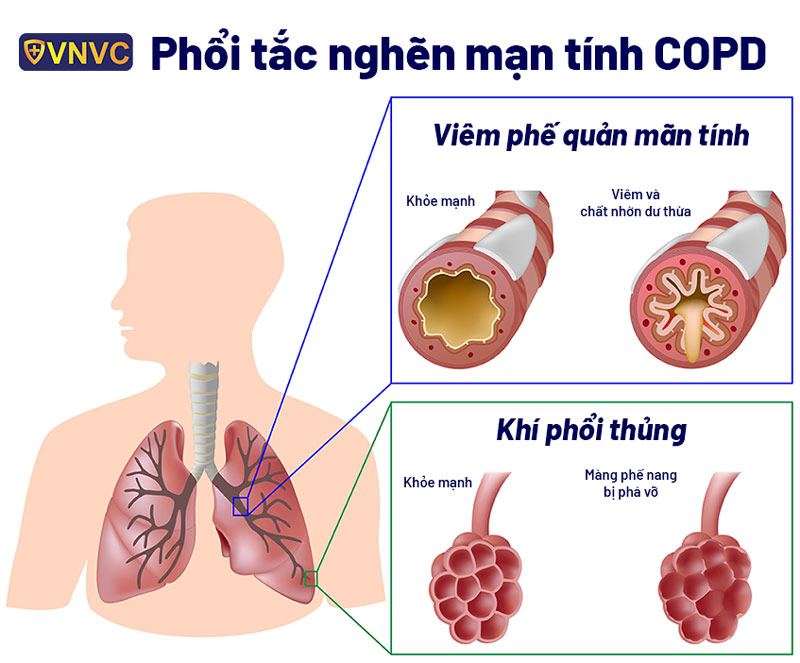 viêm phế quản và copd - Image 5