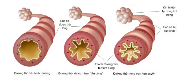 viêm phế quản và hen phế quản - Image 2