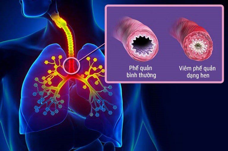 viêm phế quản và hen phế quản