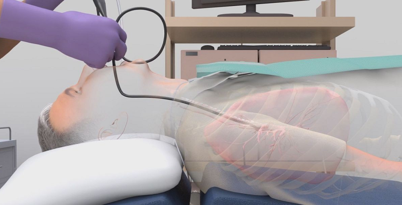 viêm phổi bệnh viện ở người lớn - Image 3
