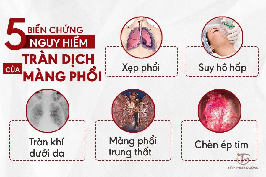 viêm phổi có dịch màng phổi - Image 2