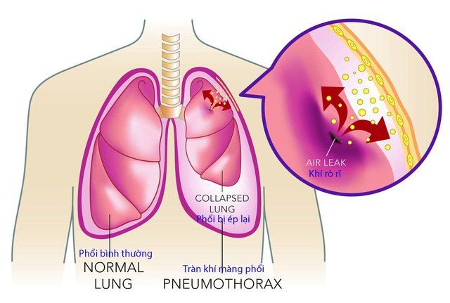 viêm phổi có dịch màng phổi - Image 3