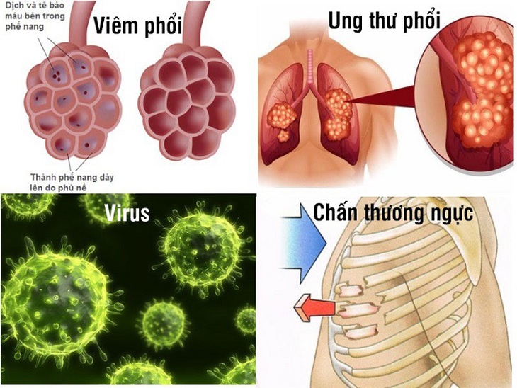 viêm phổi có dịch màng phổi - Image 5