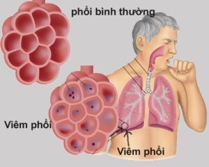 viêm phổi có nguy hiểm không