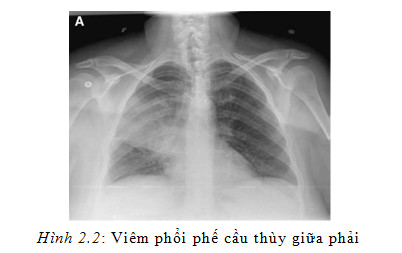 viêm phổi do vi khuẩn ở người lớn - Image 2