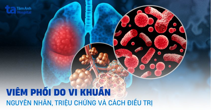 viêm phổi do vi khuẩn ở người lớn - Image 5