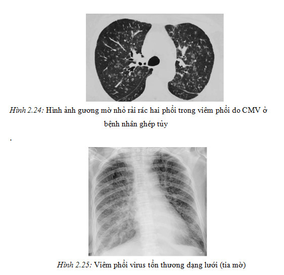 viêm phổi do virus ở người lớn - Image 3