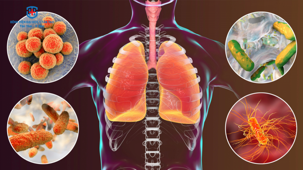 viêm phổi do virus ở người lớn - Image 4