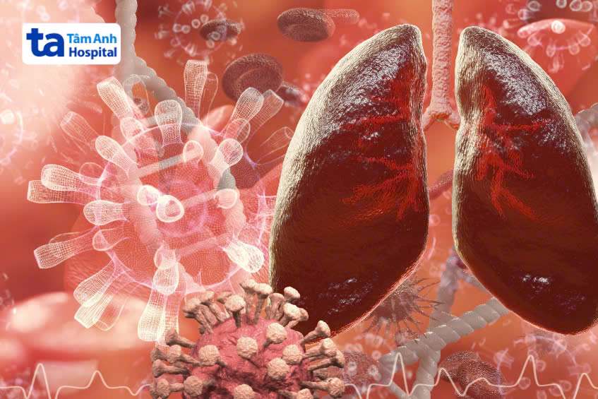 viêm phổi do virus ở người lớn - Image 5