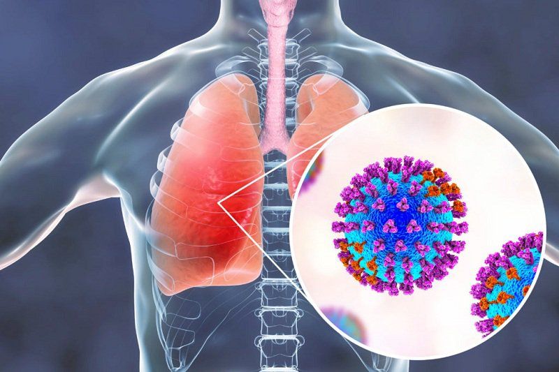 viêm phổi do virus ở người lớn