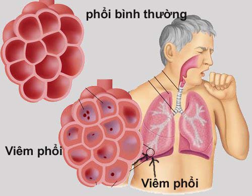 viêm phổi là gì - Image 3