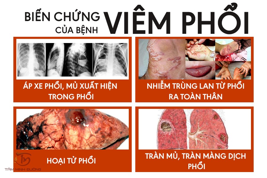 viêm phổi là gì - Image 4