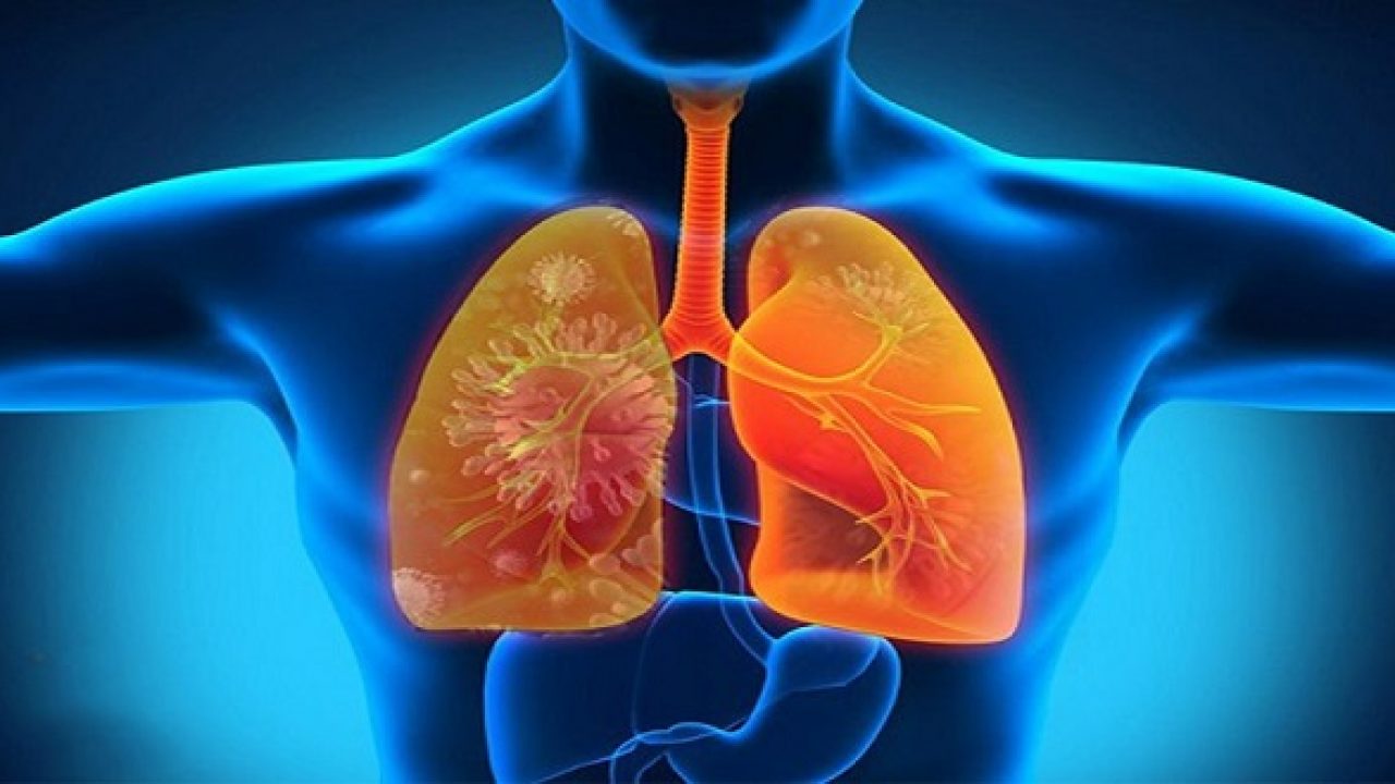 viêm phổi ở người lớn - Image 4