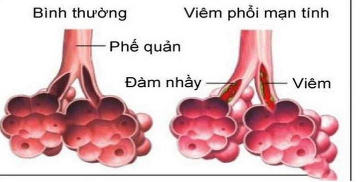 viêm phổi ở người lớn - Image 1