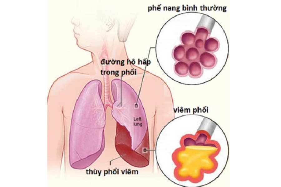 viêm phổi ở người suy tim - Image 2
