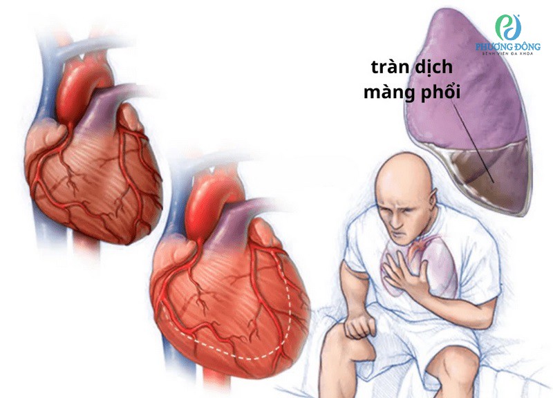 viêm phổi ở người suy tim - Image 4