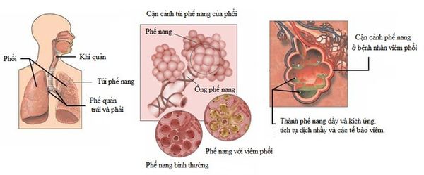 viêm phổi ở người tiểu đường - Image 2