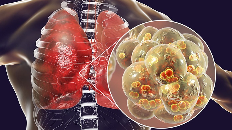 viêm phổi ở người tiểu đường