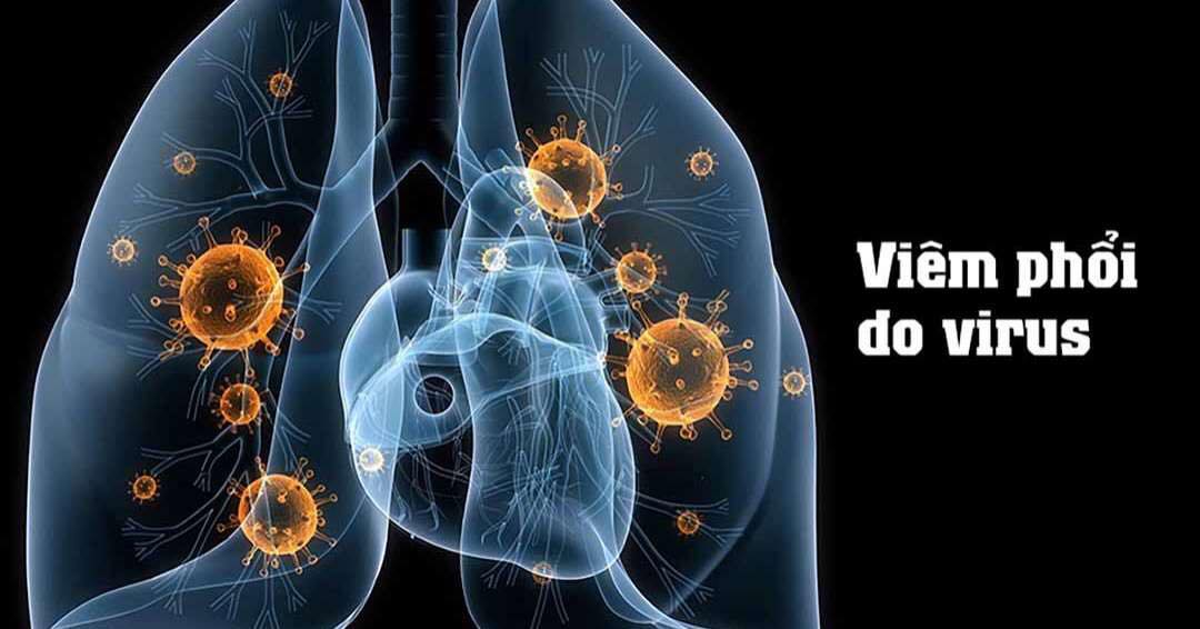 viêm phổi sau nhiễm virus - Image 4