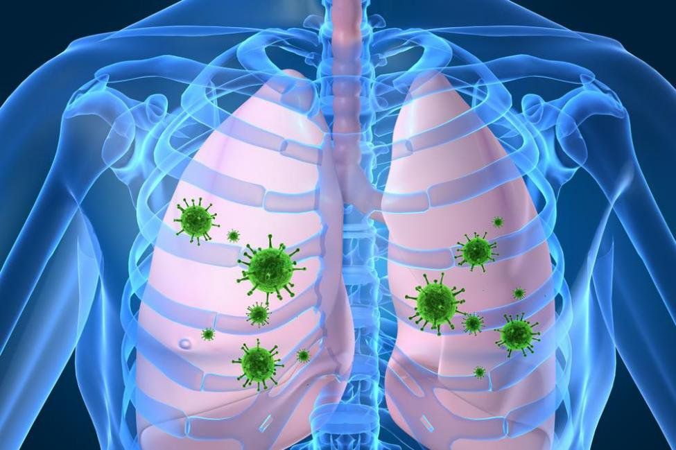 viêm phổi sau nhiễm virus