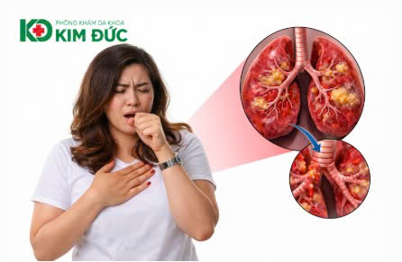 viêm phổi tái phát ở người lớn - Image 2