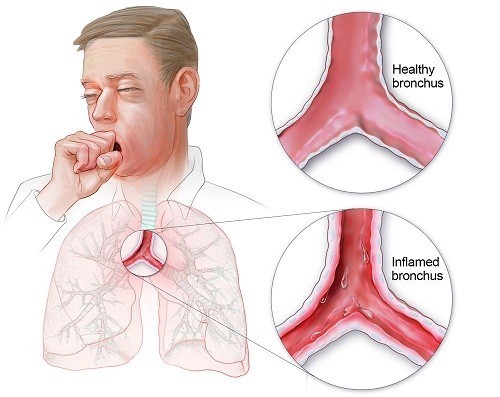 viêm phổi tái phát ở người lớn - Image 3