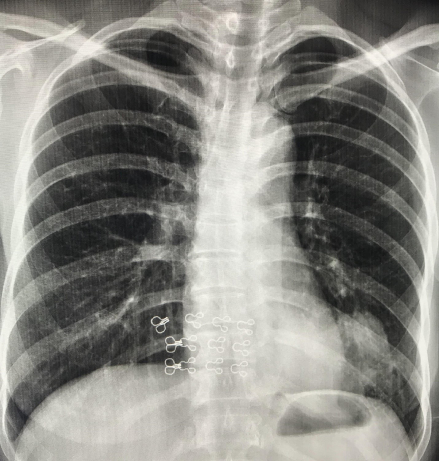 viêm phổi tái phát ở người lớn - Image 1