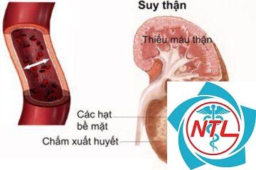 viêm thận cấp - Image 4