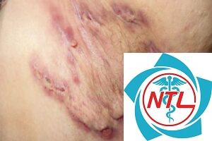 viêm tuyến mồ hôi