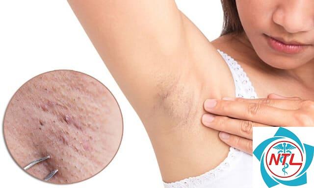 viêm tuyến mồ hôi mủ ở nách