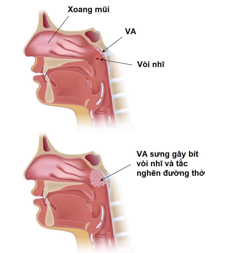 viêm va là gì - Image 3