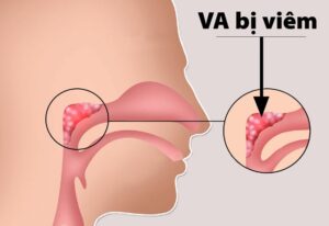 viêm va là gì