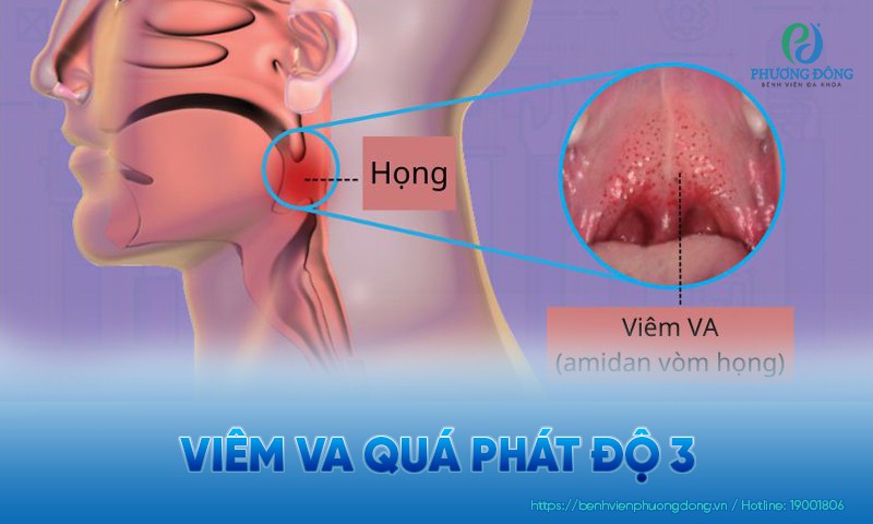 viêm va là gì - Image 4