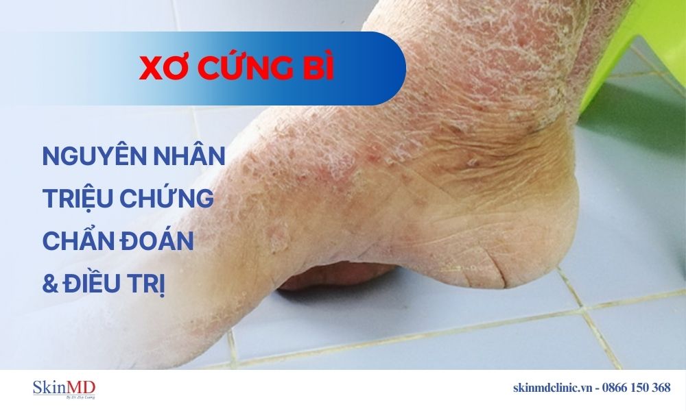 xơ cứng bì da - Image 4
